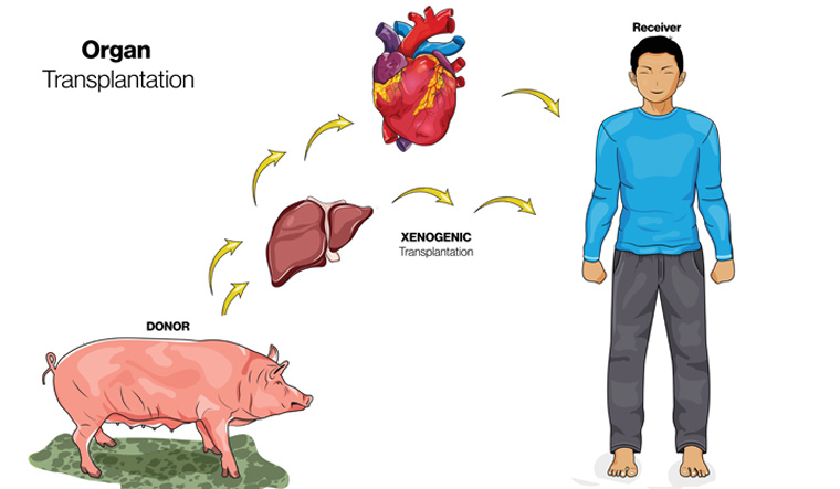 transplant pig liver into human